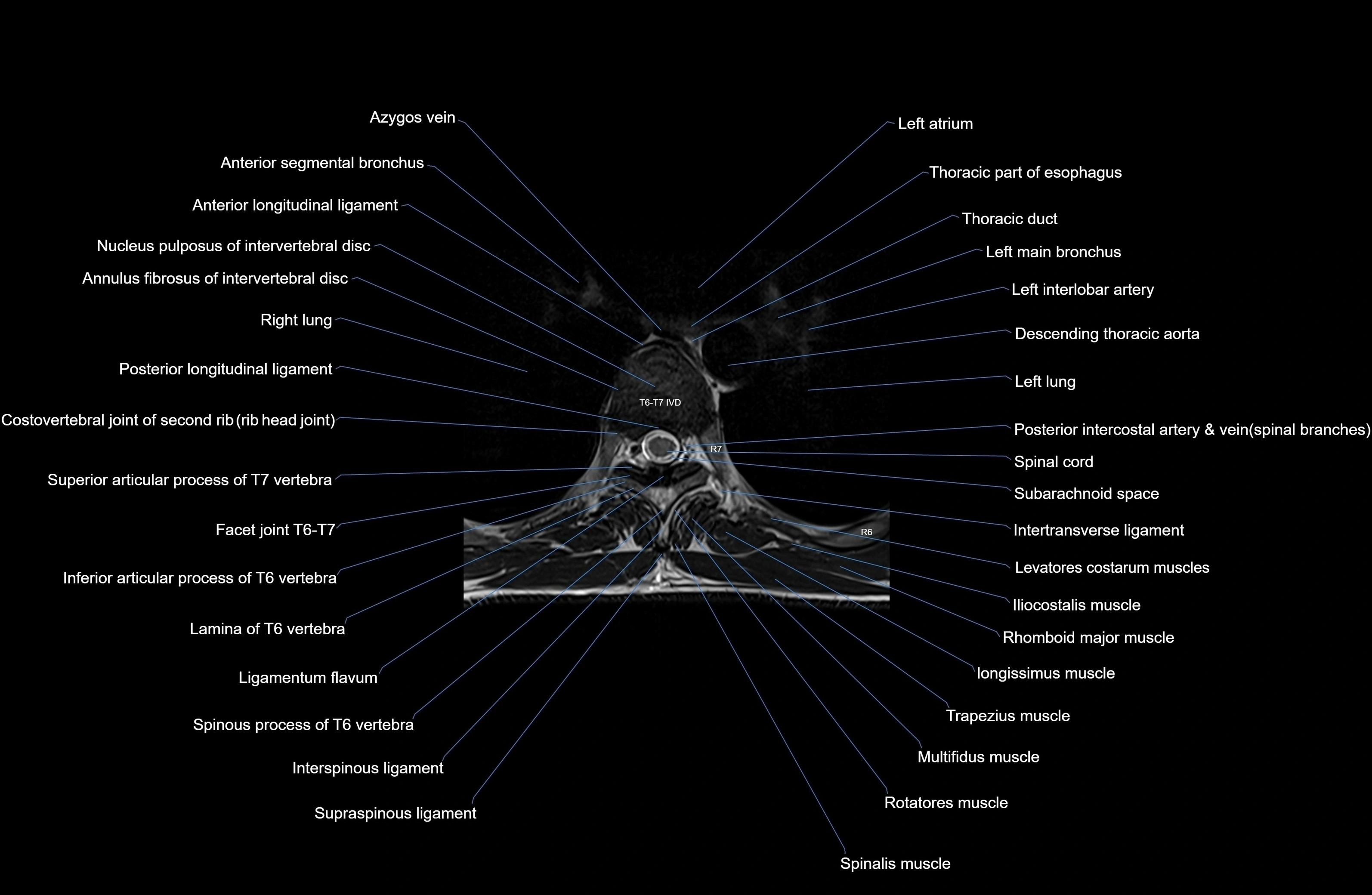 MRI thoracic spine axial  cross sectional anatomy 3T radiology  image-img-00001-00042.webp